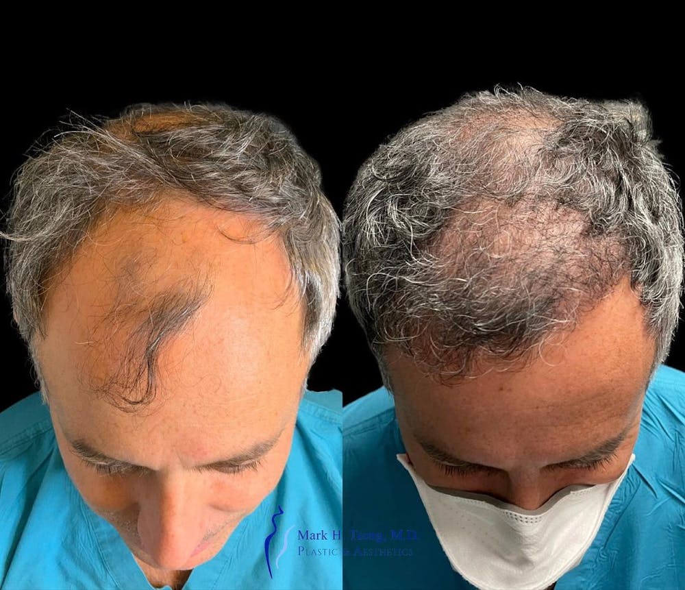 Hair Restoration Before & After Gallery - Patient 143528860 - Image 1