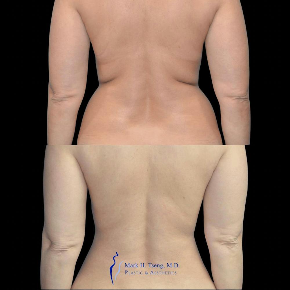 Back Liposuction Before & After Gallery - Patient 146990036 - Image 1