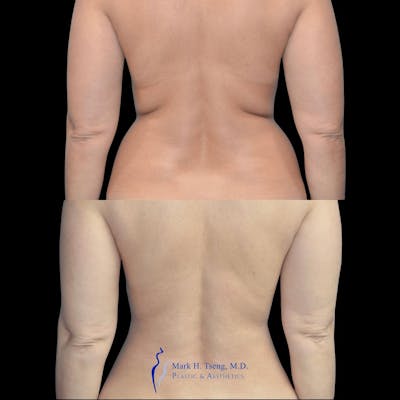 Back Liposuction Before & After Gallery - Patient 146990036 - Image 1
