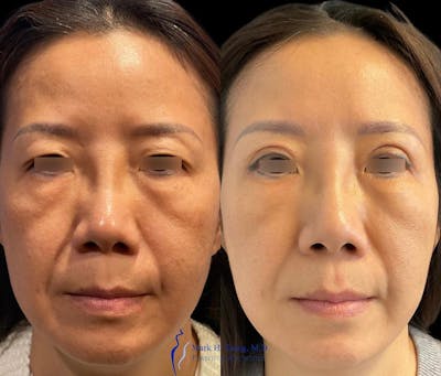 Eyelid Surgery Before & After Gallery - Patient 146225280 - Image 1