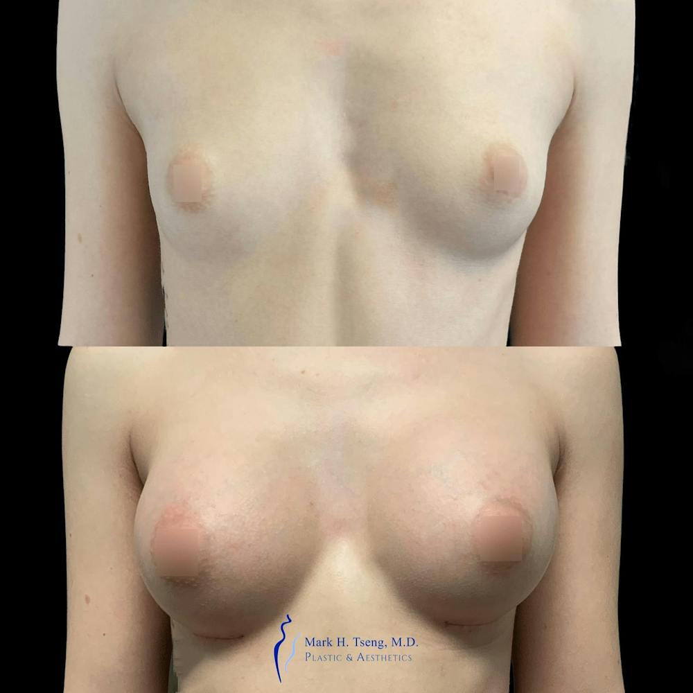 Breast Augmentation Before & After Gallery - Patient 146225284 - Image 1