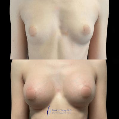 Breast Augmentation Before & After Gallery - Patient 146225284 - Image 1