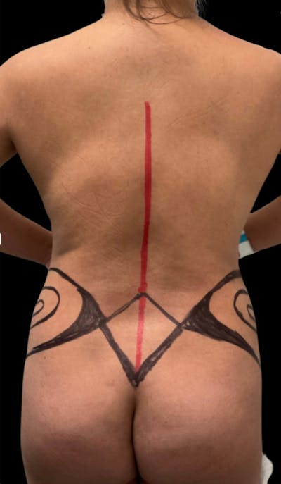 Back Liposuction Before & After Gallery - Patient 146990192 - Image 1