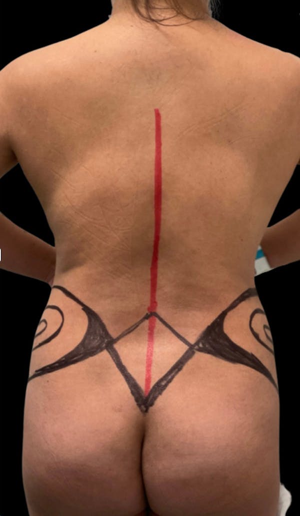 Back Liposuction Before & After Gallery - Patient 146990192 - Image 1