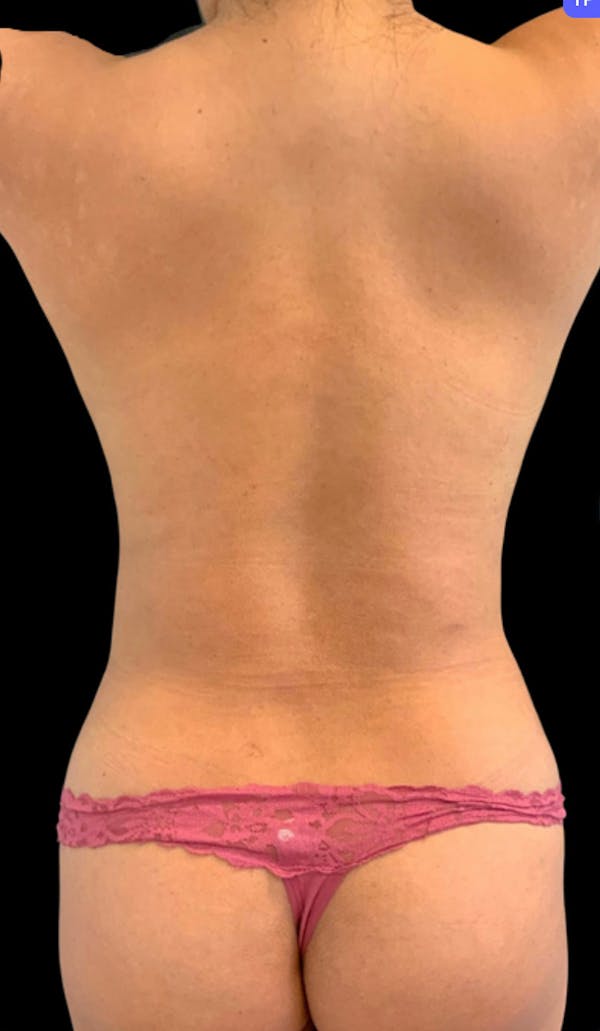 Back Liposuction Before & After Gallery - Patient 146990192 - Image 2