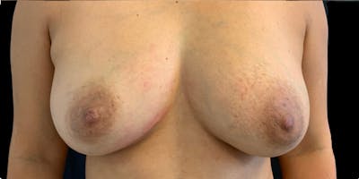Fat Transfer Breast Augmentation Before & After Gallery - Patient 146287079 - Image 4