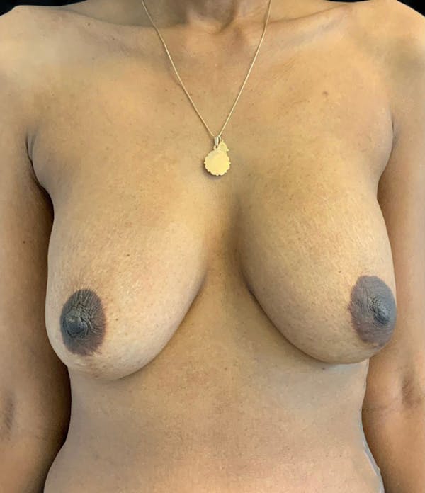 Breast Lift (Mastopexy) Before & After Gallery - Patient 146287200 - Image 1