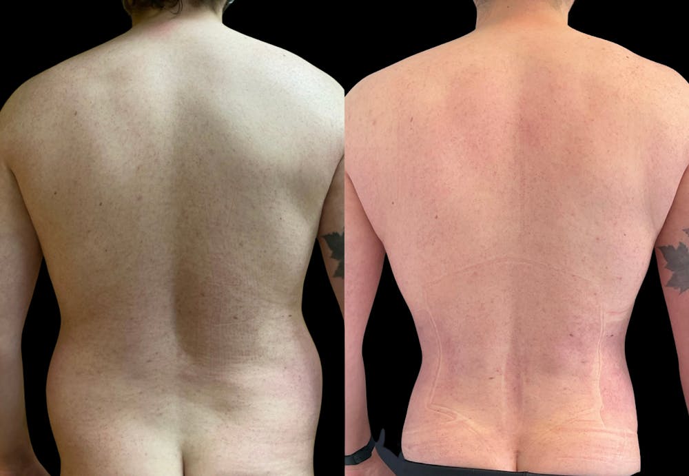 Back Liposuction Before & After Gallery - Patient 146464767 - Image 1