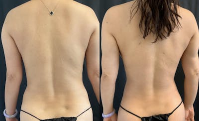 Back Liposuction Before & After Gallery - Patient 146464768 - Image 1