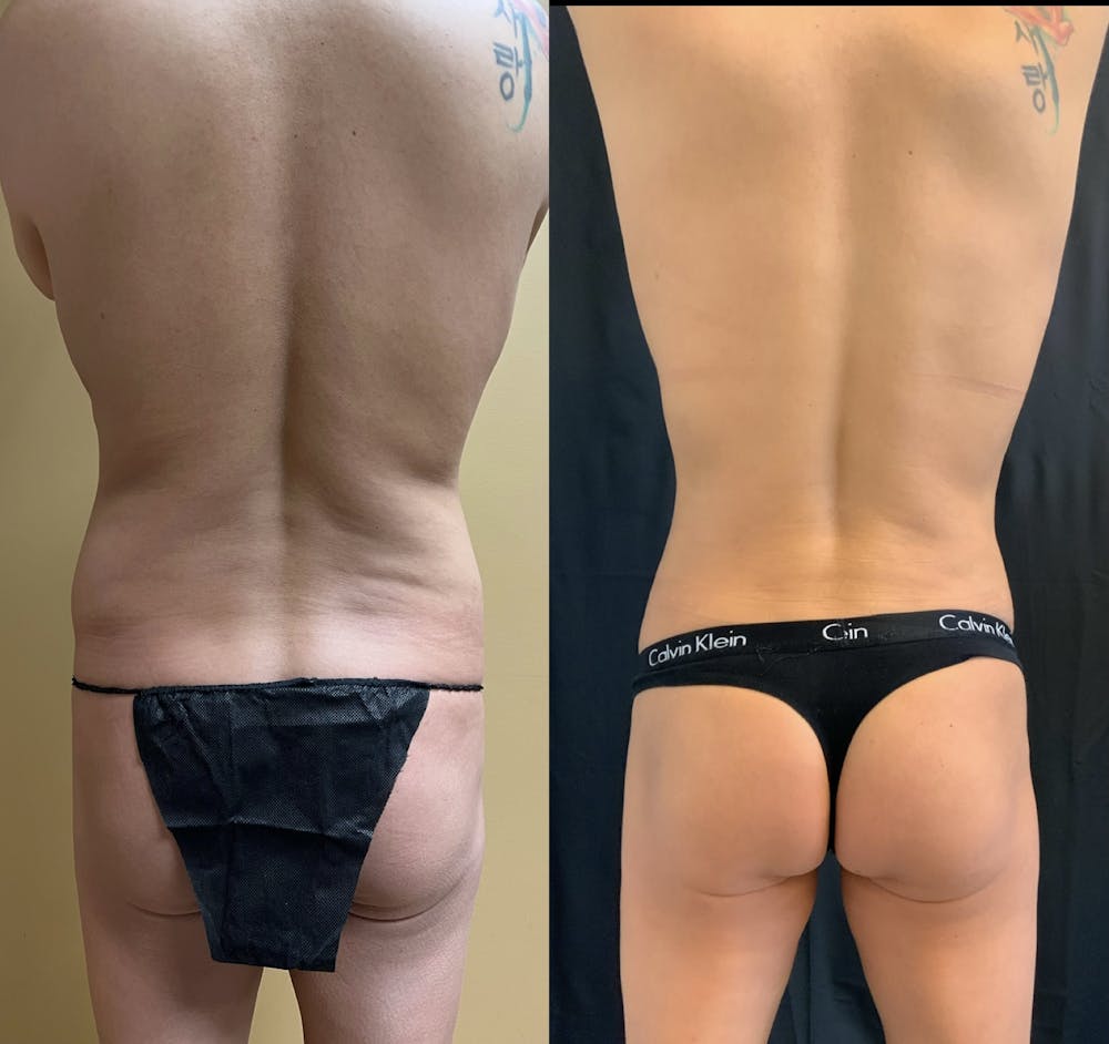 Back Liposuction Before & After Gallery - Patient 146464769 - Image 1