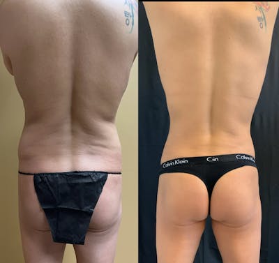 Back Liposuction Before & After Gallery - Patient 146464769 - Image 1