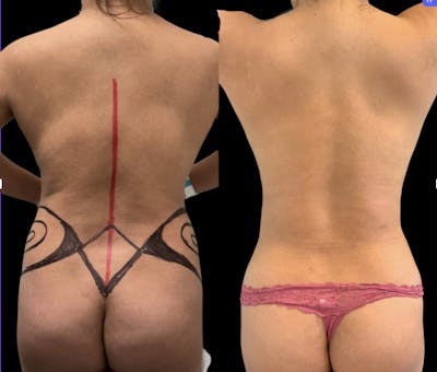 Back Liposuction Before & After Gallery - Patient 146464770 - Image 1