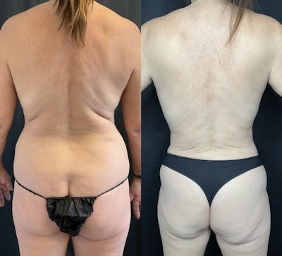 Back Liposuction Before & After Gallery - Patient 146464771 - Image 1