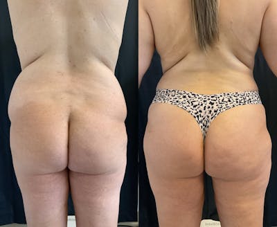 Back Liposuction Before & After Gallery - Patient 146464772 - Image 1