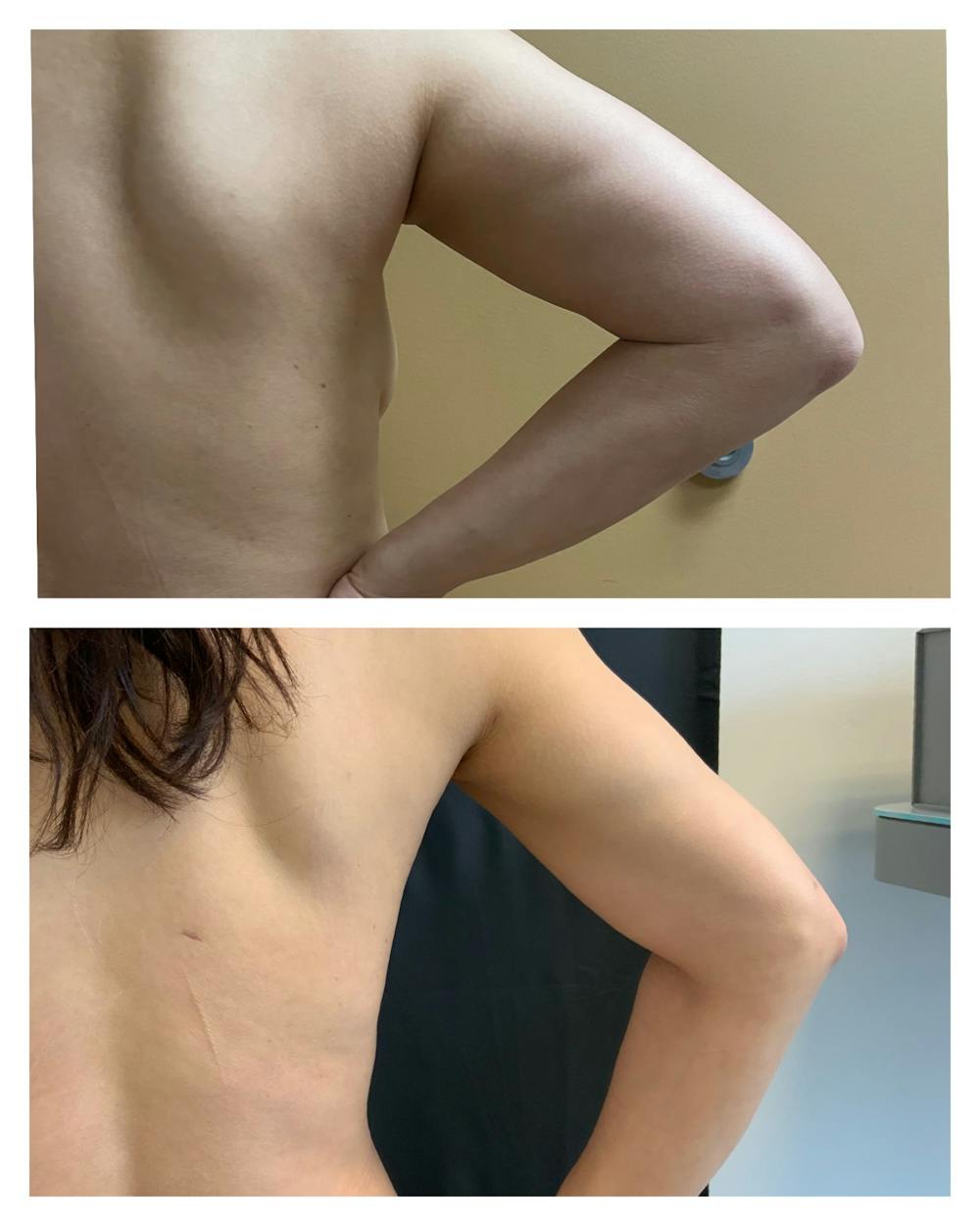 Arm Liposuction Before & After Gallery - Patient 146464792 - Image 2