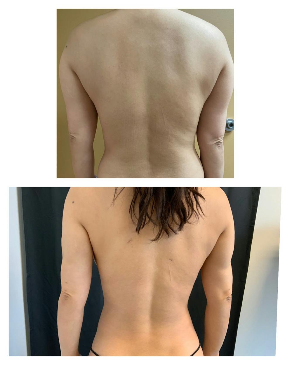 Arm Liposuction Before & After Gallery - Patient 146464793 - Image 1