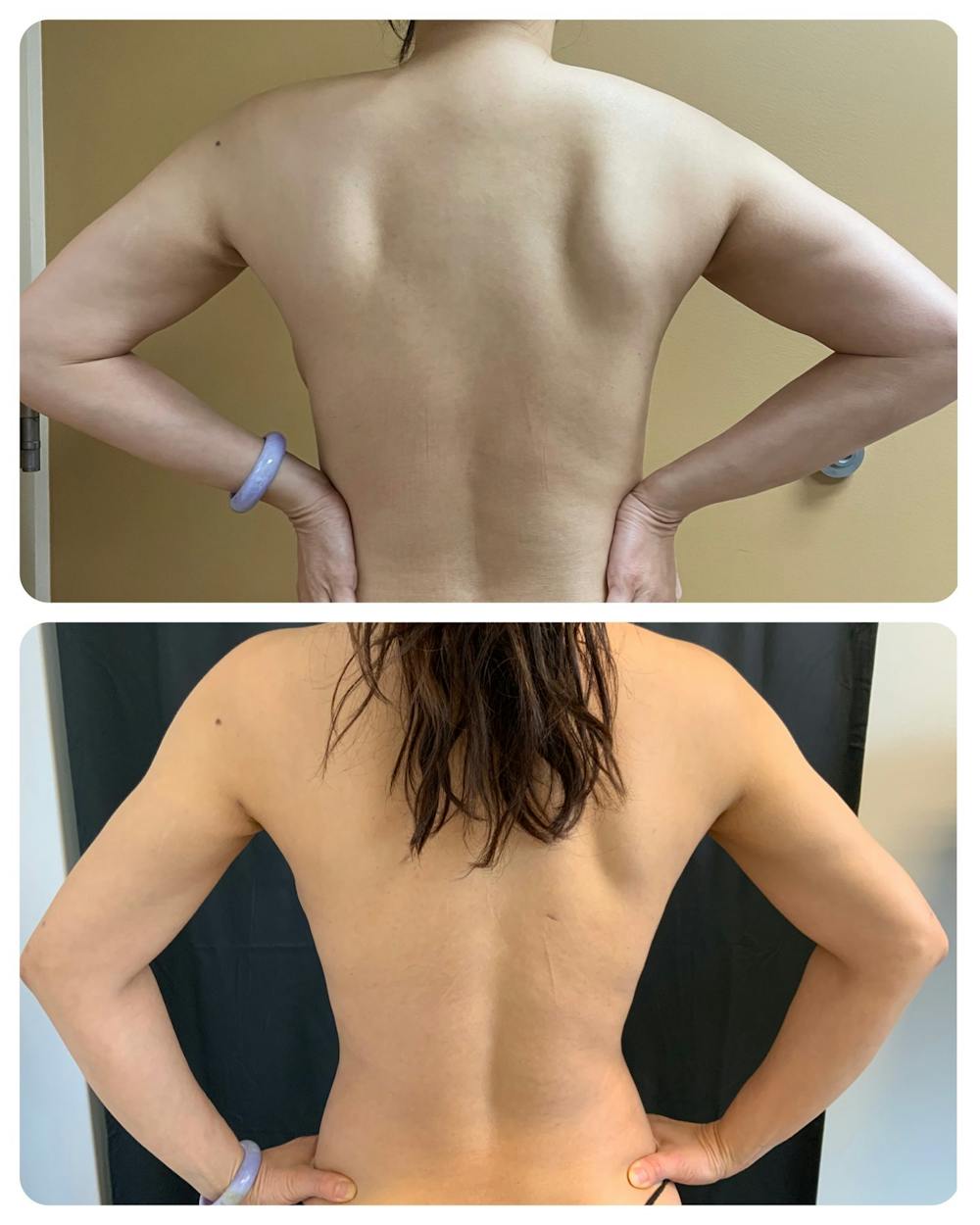 Arm Liposuction Before & After Gallery - Patient 146464792 - Image 1