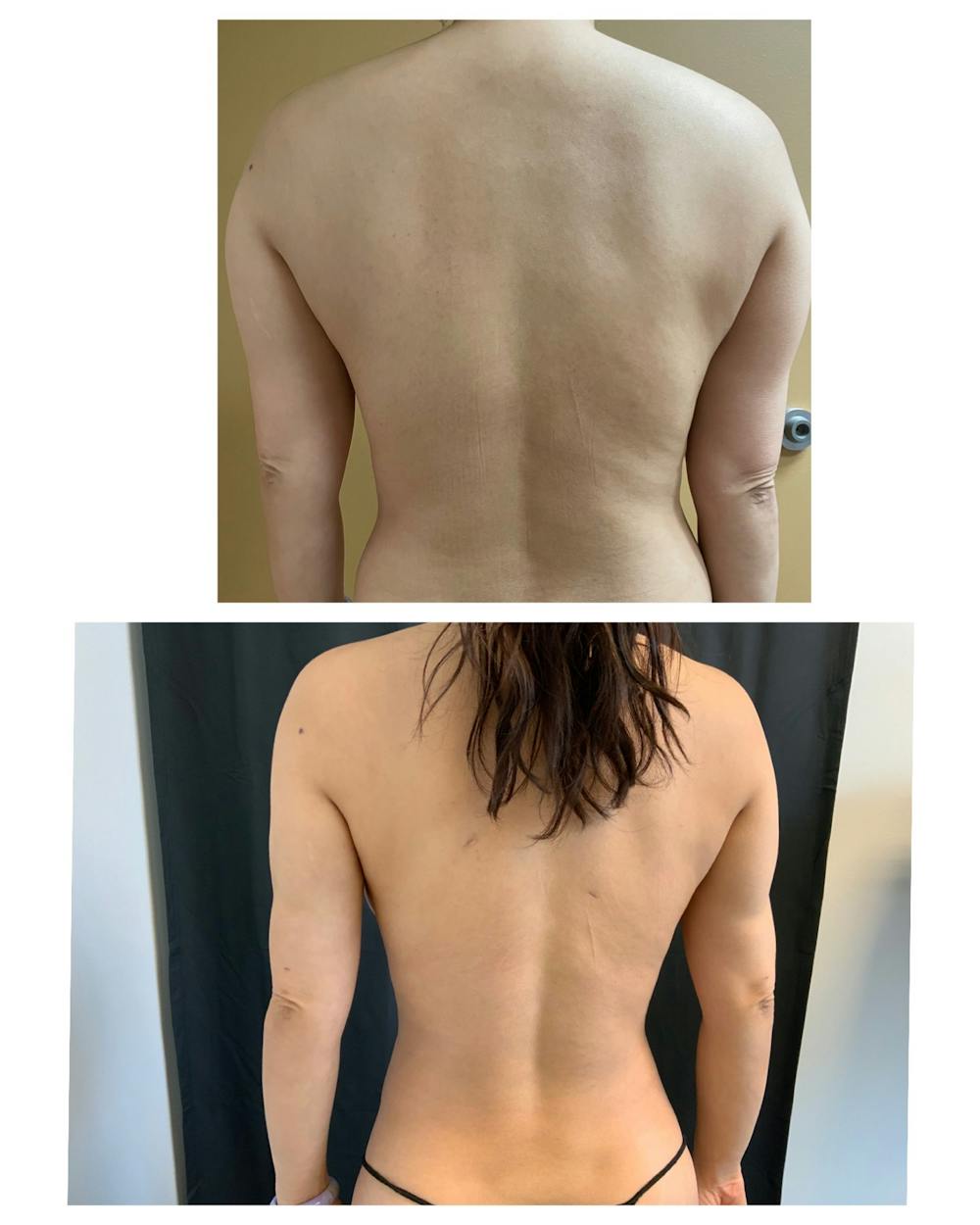 Arm Liposuction Before & After Gallery - Patient 146464793 - Image 3