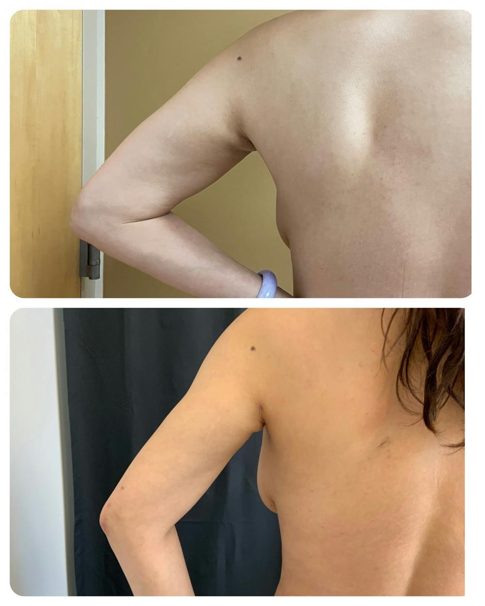 Arm Liposuction Before & After Gallery - Patient 146464792 - Image 3