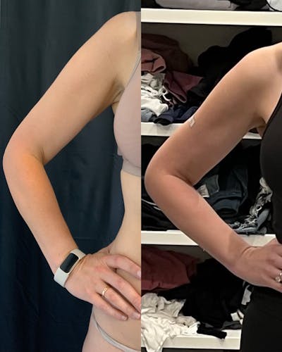 Arm Liposuction Before & After Gallery - Patient 146464794 - Image 1