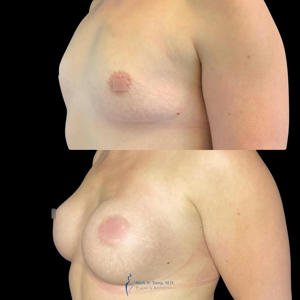 Breast Augmentation Before & After Gallery - Patient 146900338 - Image 1