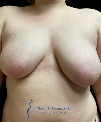 Breast Lift (Mastopexy) Before & After Gallery - Patient 146900361 - Image 1