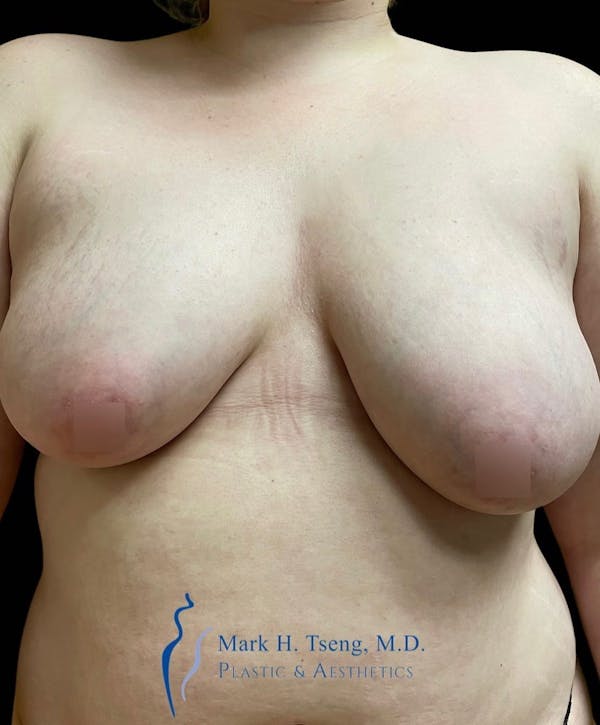 Breast Lift (Mastopexy) Before & After Gallery - Patient 146900361 - Image 1