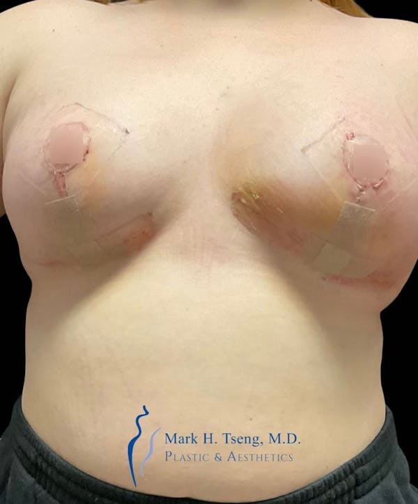 Breast Lift (Mastopexy) Before & After Gallery - Patient 146900361 - Image 2