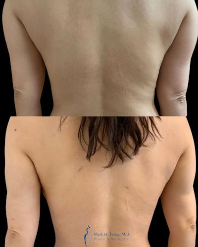 Arm Liposuction Before & After Gallery - Patient 146900363 - Image 1