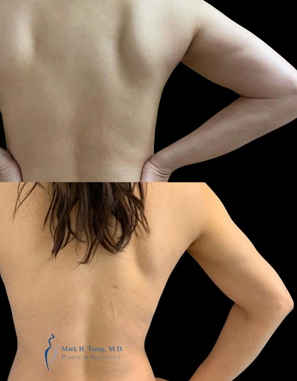 Arm Liposuction Before & After Gallery - Patient 146900363 - Image 2