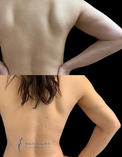 Arm Liposuction Before & After Gallery - Patient 146900363 - Image 2
