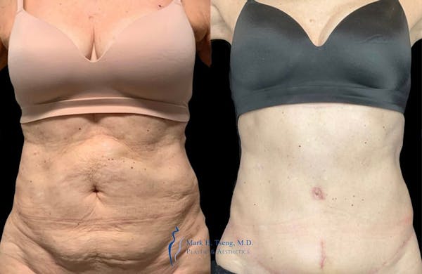 Tummy Tuck (Abdominoplasty)  Before & After Gallery - Patient 146900365 - Image 1