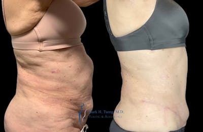 Tummy Tuck (Abdominoplasty)  Before & After Gallery - Patient 146900365 - Image 2