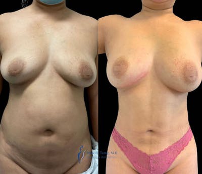 Fat Transfer Breast Augmentation Before & After Gallery - Patient 146900368 - Image 1