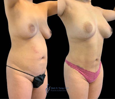 Abdomen Liposuction Before & After Gallery - Patient 146990060 - Image 2