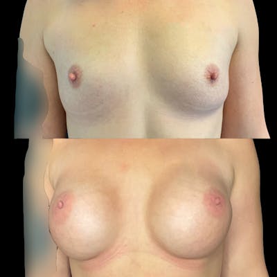 Breast Augmentation Before & After Gallery - Patient 146959844 - Image 1