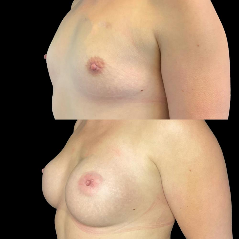 Breast Augmentation Before & After Gallery - Patient 146959844 - Image 2