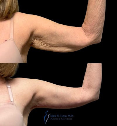 Arm Lift Before & After Gallery - Patient 143528802 - Image 1