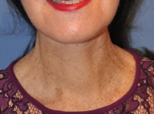 Before and After a Neck Lift in Newport Beach