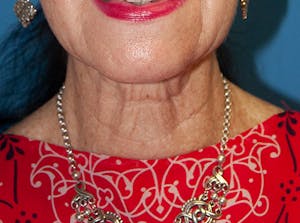 Before and After a Neck Lift in Newport Beach
