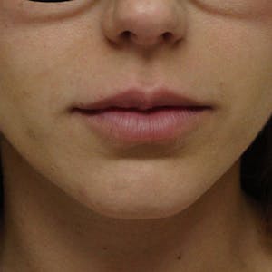 Before and After Lip Augmentation in Newport Beach