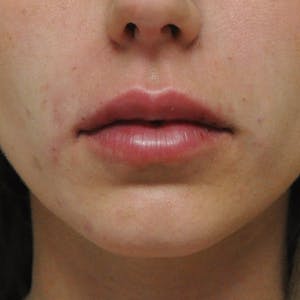 Before and After Lip Augmentation in Newport Beach