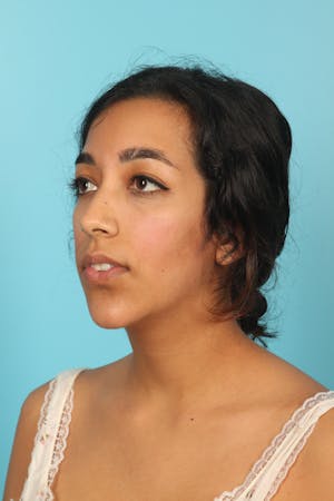 Chin Augmentation