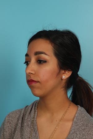 Chin Augmentation