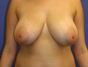 Before and After Breast Reduction in Newport Beach