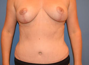 Newport Beach Breast Lift Patient Before & After Photo
