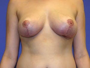 Before and After Breast Reduction in Newport Beach