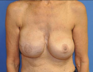 Before and After Breast Reconstruction in Newport Beach