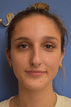 Liquid Rhinoplasty