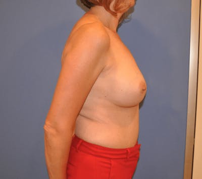 Breast Reconstruction Before & After Gallery - Patient 13574538 - Image 1